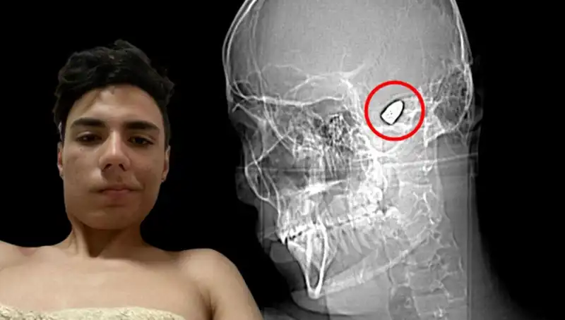 Kafasında Patlayıcı Var: Bu Hayat Mücadelesi Gözleri Yüreklendiriyor